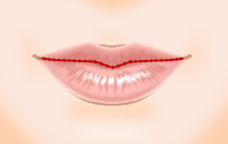 口唇縮小術の施術プロセス その6