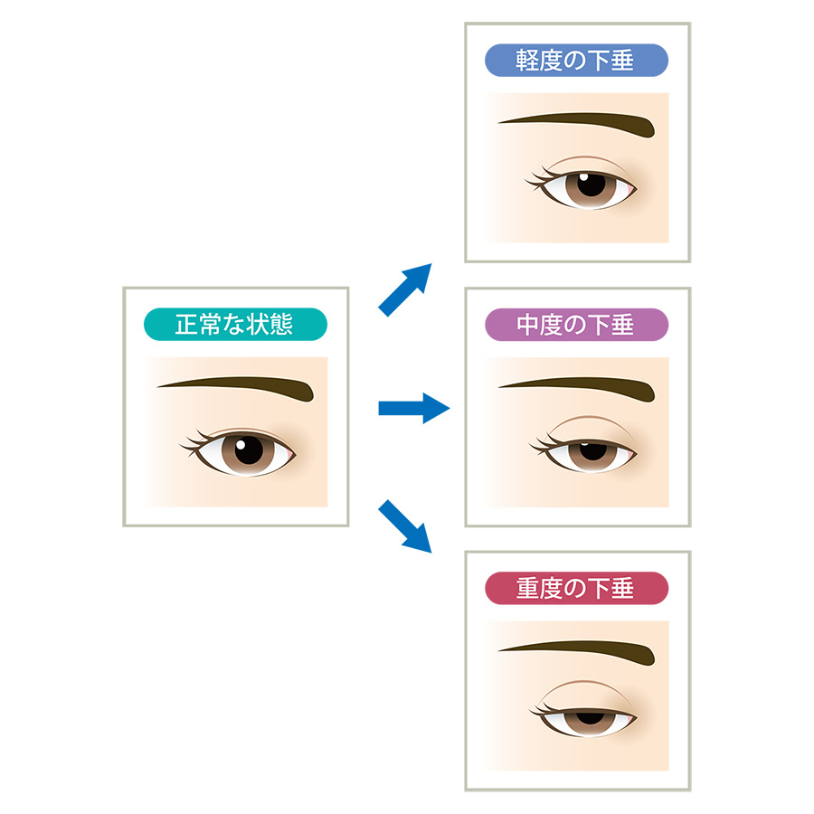 眼瞼下垂とは？