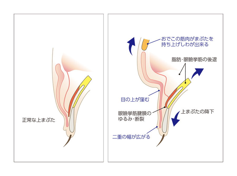 眼瞼下垂の症状