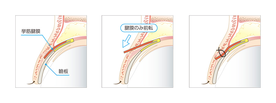 眼瞼下垂の手術の仕組み