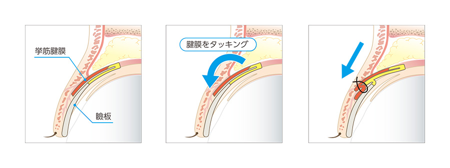 先天性の眼瞼下垂のように筋肉の力が弱く目が開きづらい方の場合