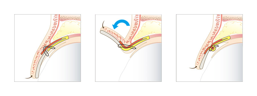 切らない眼瞼下垂の治療法