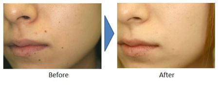 顔のホクロ除去の症例 Co2レーザー 美容整形 大塚美容形成外科公式ブログ