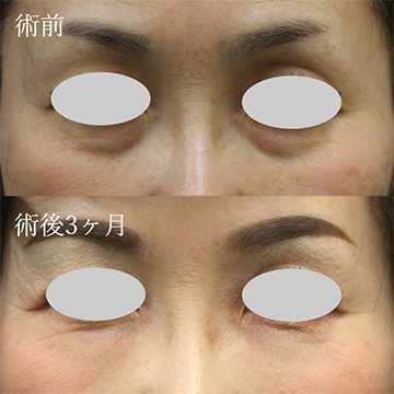 マフトガンによる脂肪移植（脂肪注入）