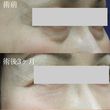 マフトガンによる脂肪移植（脂肪注入）