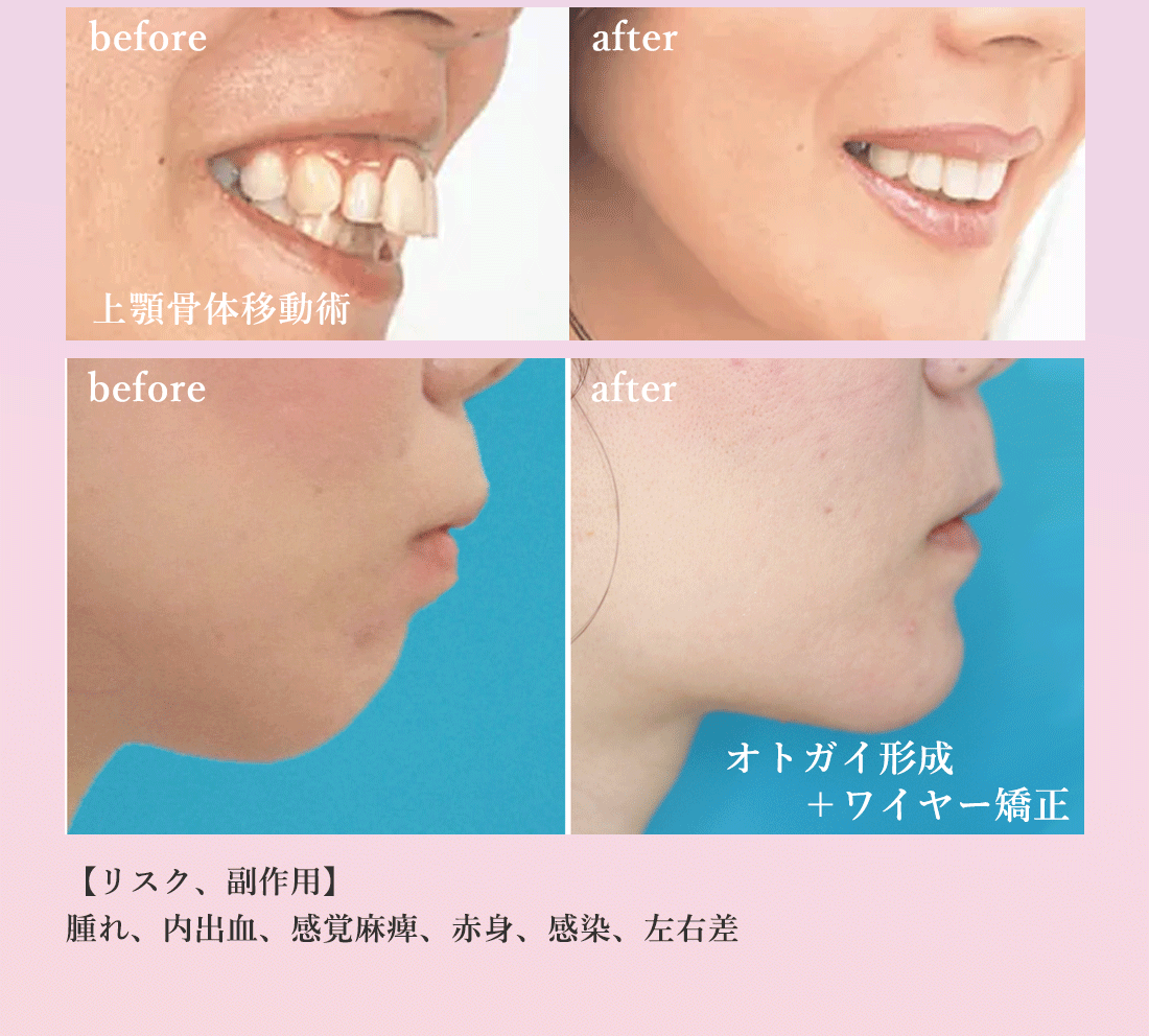 上下骨体移動術・オトガイ形成　症例