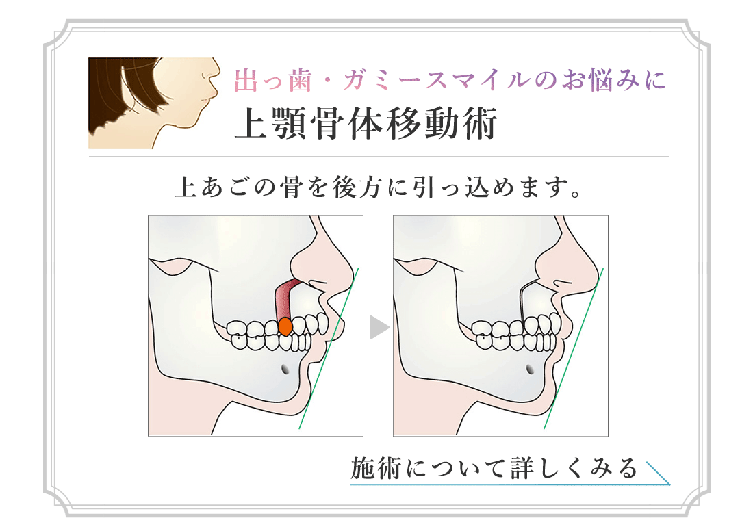 出っ歯・ガミースマイルのお悩みに　上顎骨体移動術