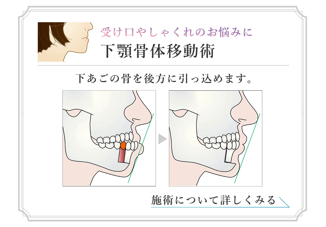 受け口やしゃくれのお悩みに　下顎骨体移動術