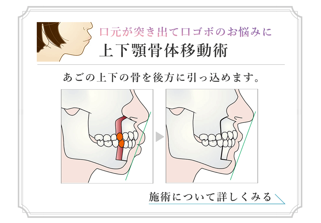 口元が突き出て口ゴボのお悩みに　上下顎骨体移動術