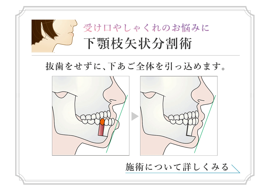 受け口やしゃくれのお悩みに　下顎枝矢状分割術