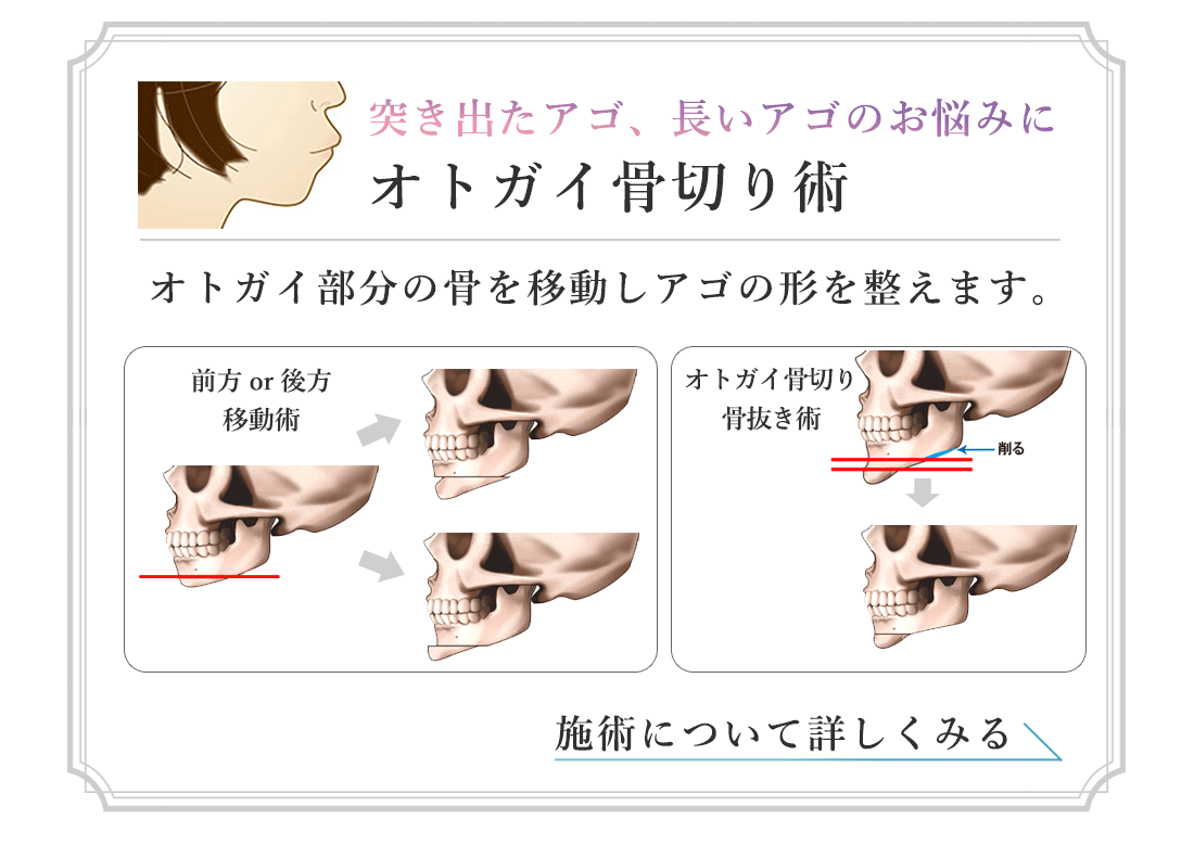 突き出たアゴ、長いアゴのお悩みに オトガイ骨切り術