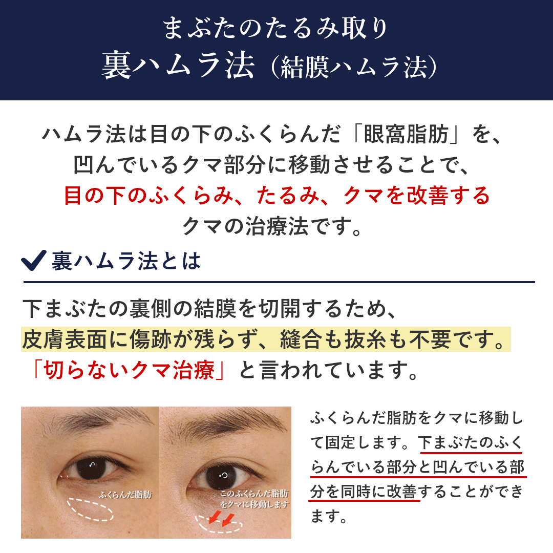 裏ハムラ法とは