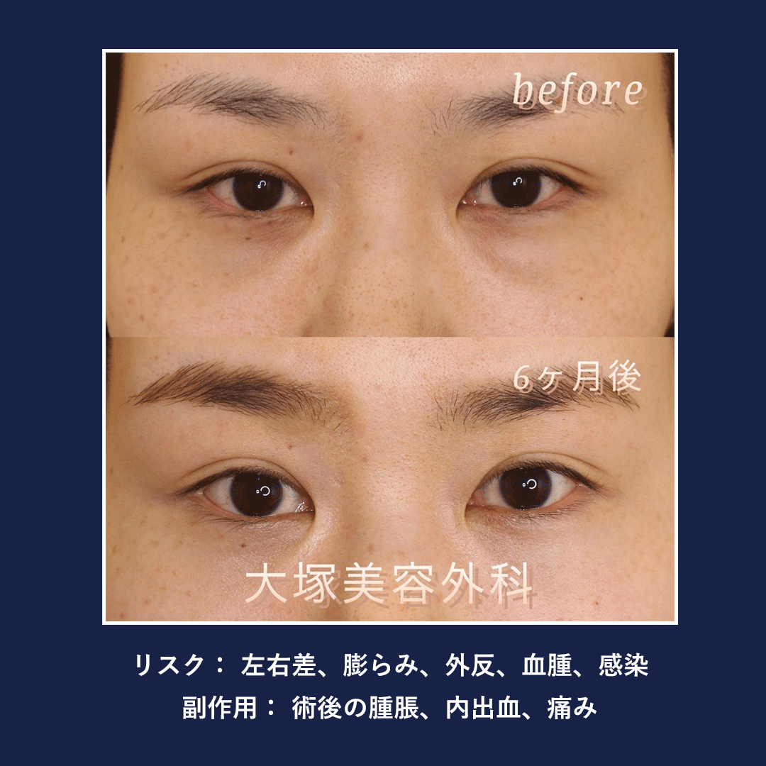 裏ハムラ法の症例