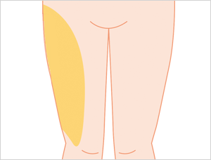 ボディデザイン法のそれぞれの脂肪吸引範囲 大腿（外側）