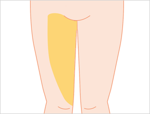 ボディデザイン法のそれぞれの脂肪吸引範囲 大腿（内側）