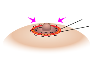 乳輪外側の皮膚を切除縫合し乳輪を縮める方法のプロセス4