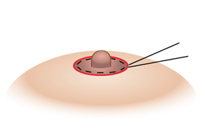 乳輪外側の皮膚を切除縫合し乳輪を縮める方法のプロセス5