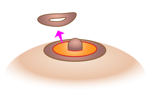 高さのある乳輪を小さくする方法のプロセス2