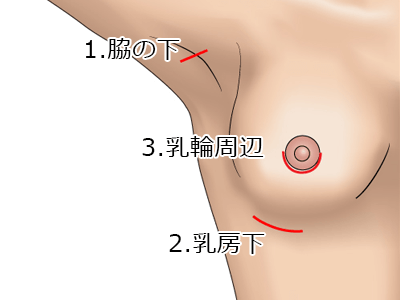 豊胸バッグ挿入時の切開部分