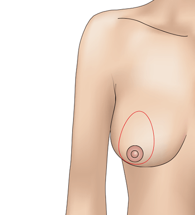 乳房挙上術（ドーナッツペクシー法）のプロセス1