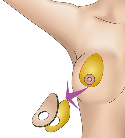 乳房挙上術（ドーナッツペクシー法）のプロセス2