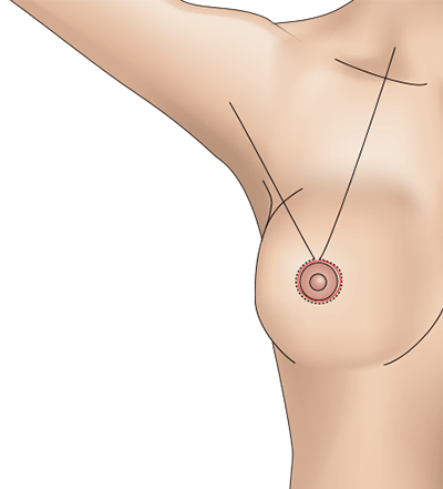 乳房挙上術（ドーナッツペクシー法）のプロセス4
