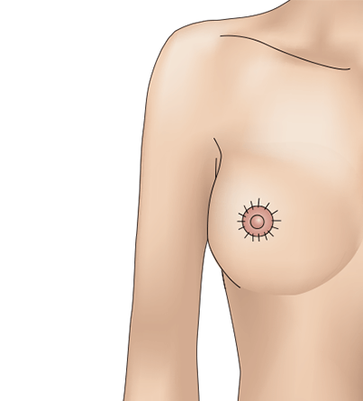 乳房挙上術（ドーナッツペクシー法）のプロセス5