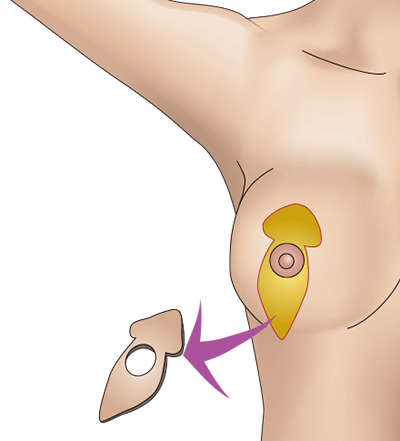 乳房挙上術（バーティカル法）のプロセス3