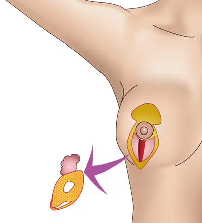 乳房挙上術（バーティカル法）のプロセス4
