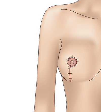 乳房挙上術（バーティカル法）のプロセス6