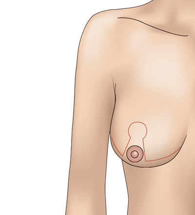 乳房縮小（逆T字型）のプロセス1
