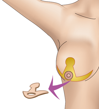 乳房縮小（逆T字型）のプロセス2