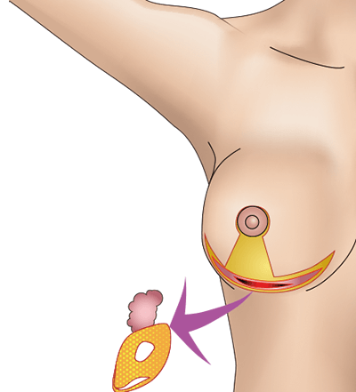 乳房挙上術（逆T字型）のプロセス3