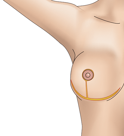 乳房挙上術（逆T字型）のプロセス4