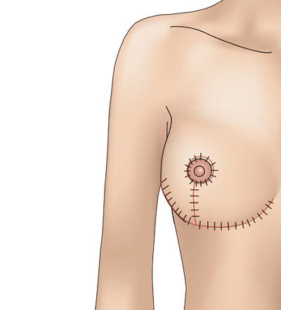 乳房挙上術（逆T字型）のプロセス5