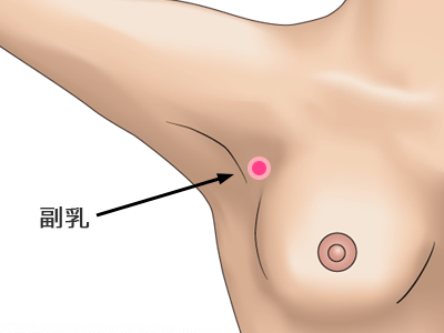 副乳除去の施術プロセス その1