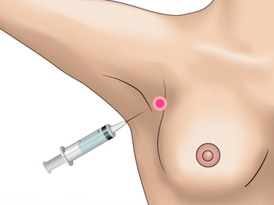 副乳除去の施術プロセス その2