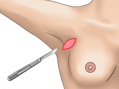 副乳除去の施術プロセス その3