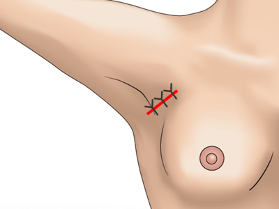 副乳除去の施術プロセス その4