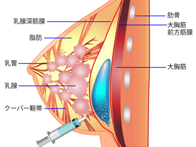 ヒアルロン酸による豊胸術の施術プロセス その3