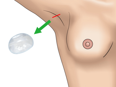 シリコンバッグ抜去の施術プロセス その4