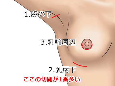 シリコンバッグ抜去の施術プロセス その3