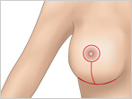 乳房挙上術（リフトアップ）