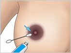 乳輪関連の施術