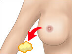 乳房の脂肪吸引