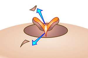 陥没乳首修正術のプロセス4