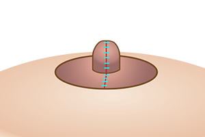 陥没乳首修正術のプロセス6