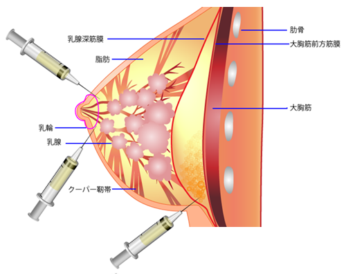 高濃度自己脂肪注入豊胸 ピュアグラフトによる脂肪注入部位