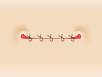 傷跡が目立たない切開法