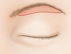 眉毛下切開法（眉下リフト）の施術プロセス その2